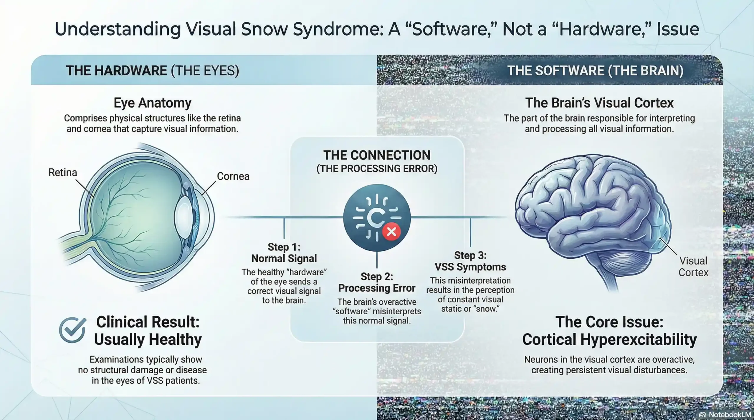 Diagram comparing healthy eye structure with the hyperactive visual cortex in Visual Snow Syndrome.